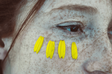 Close-up of freckled face related to hyperpigmentation