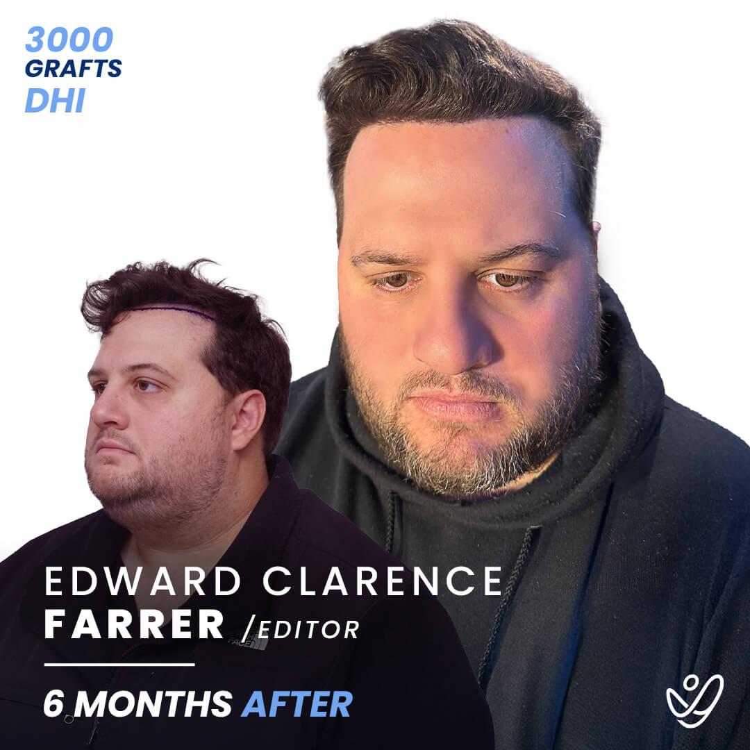 Hair transplant journey